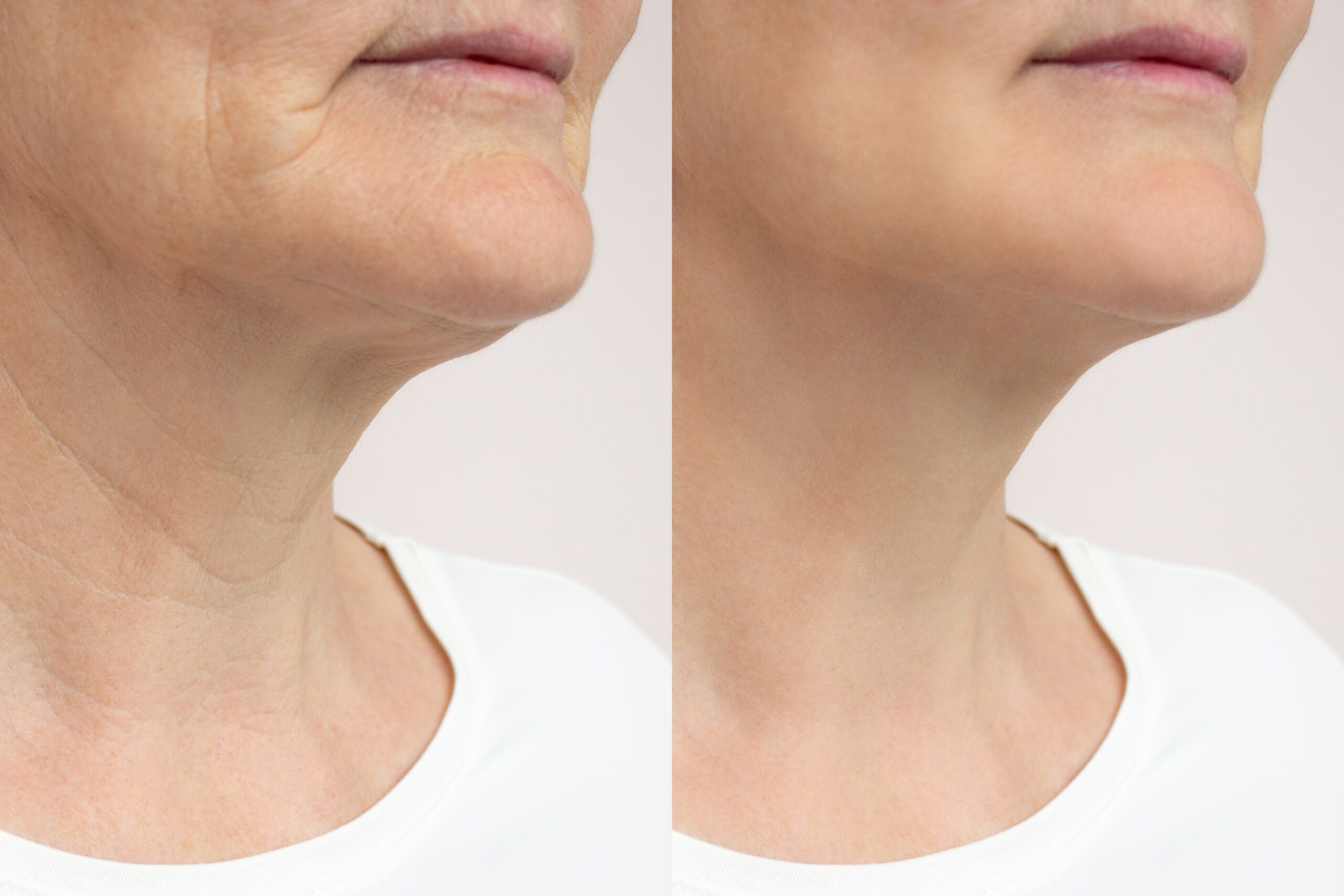 Close-up of creases and wrinkles on the neck of a elderly woman. Collage before and after the rejuvenation procedure. Beauty, plastic surgery and women's health care concept. Facelift