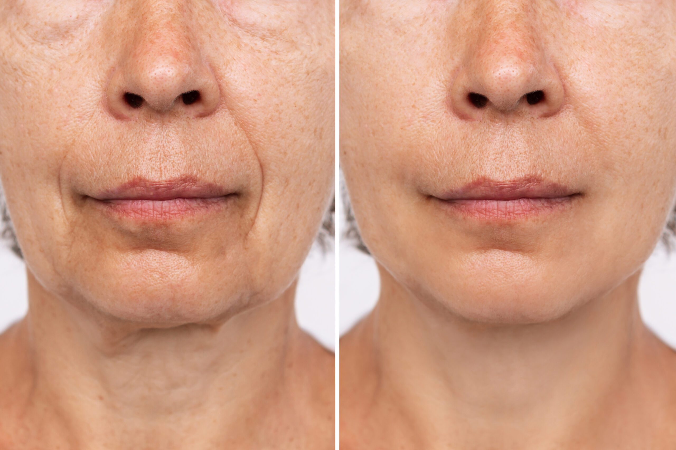 Lower part of face and neck of an elderly woman with signs of skin aging before after facelift, plastic surgery. Age-related changes, flabby sagging skin, wrinkles, creases, puffiness. Rejuvenation