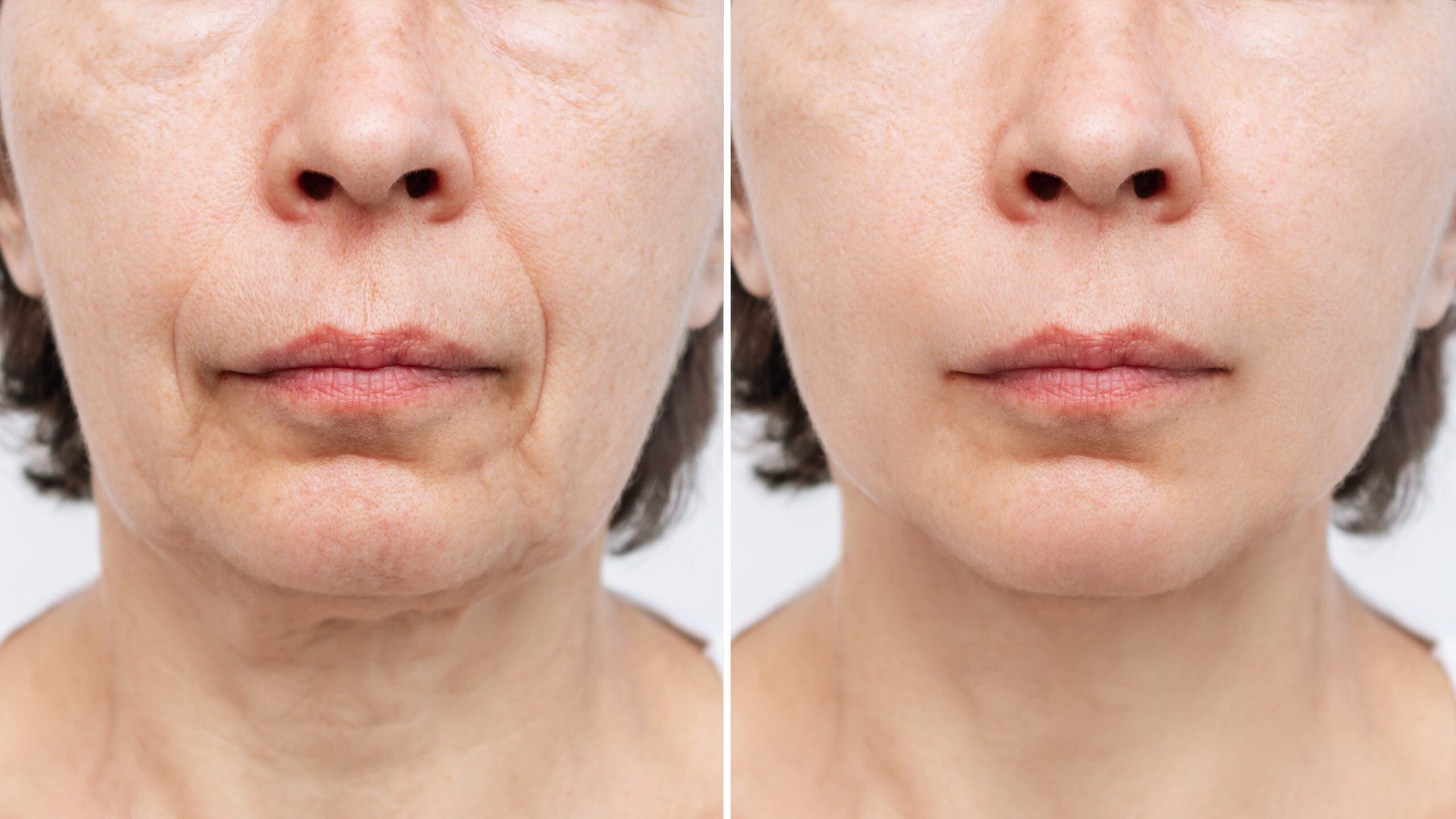 Lower part of face and neck of elderly woman with signs of skin aging before after facelift, plastic surgery on white background. Age-related changes, flabby sagging skin, wrinkles, creases, puffiness