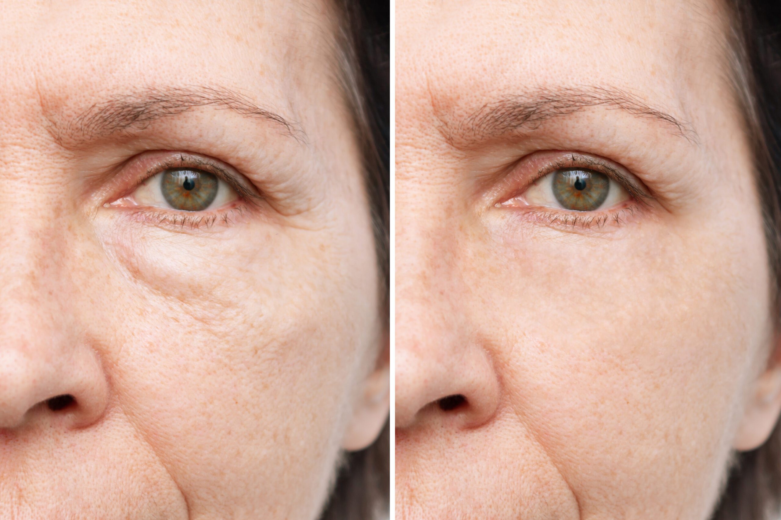 Cropped shot of an elderly caucasian woman's face with puffiness under her eyes and wrinkles before and after treatment. Age-related skin changes, fatigue. Result of blepharoplasty plastic surgery